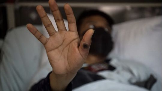 México acumula 4 mil 153 casos de Mpox y 34 decesos