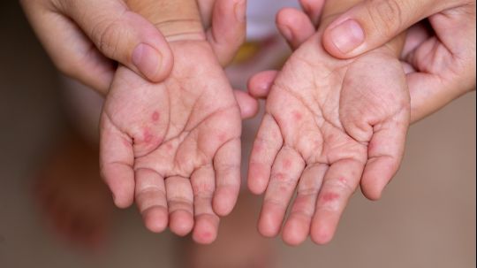 Posible brote de sarampión en Tetla enciende las alarmas